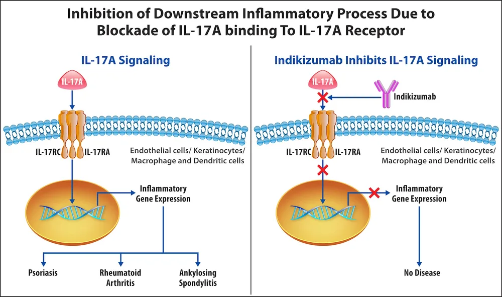 IL-17A involvement in inflammation leading to Psoriasis, Rheumatoid Arthritis, and Ankylosing Spondylitis